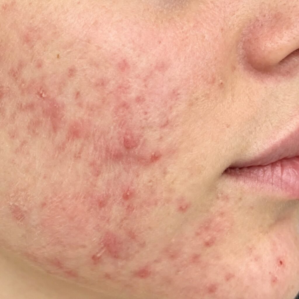 Acne-prone facial skin before professional acne treatment by hydradermabrasion facial machine