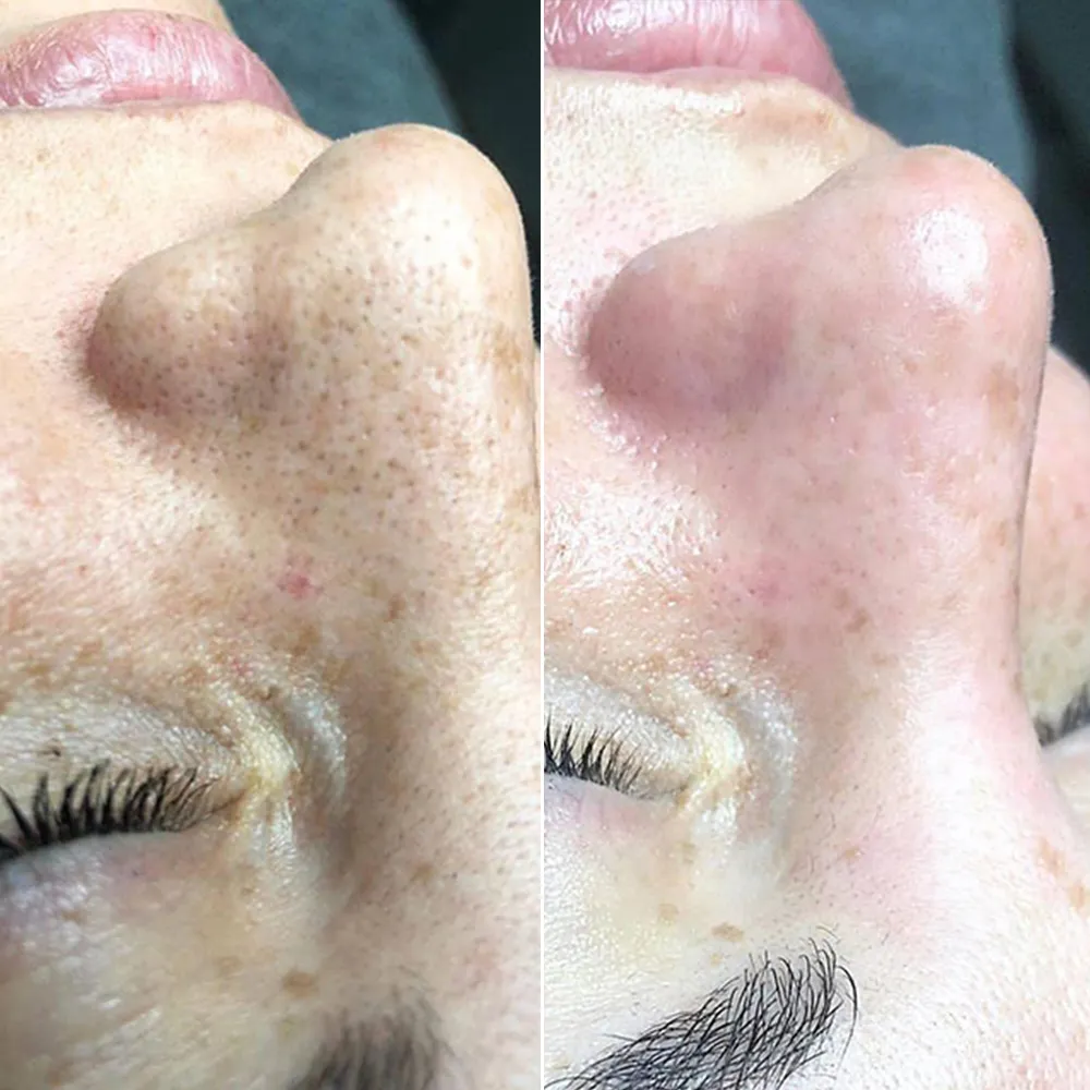 Hydradermabrasion facial machine before and after deep skin cleansing, showing blackhead removal and clearer pores