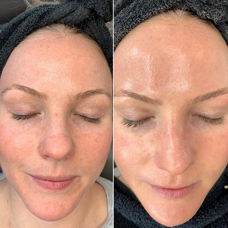 Hydradermabrasion facial machine before and after glowing skin treatment