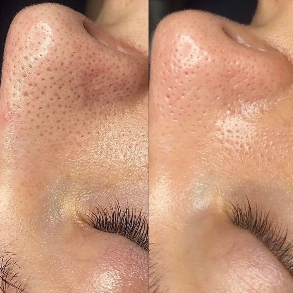 Machine hydraface hydrodermabrasion avant apres, nettoyage cutané profond du nez, élimination points noirs et impuretés, soin visage professionnel en institut