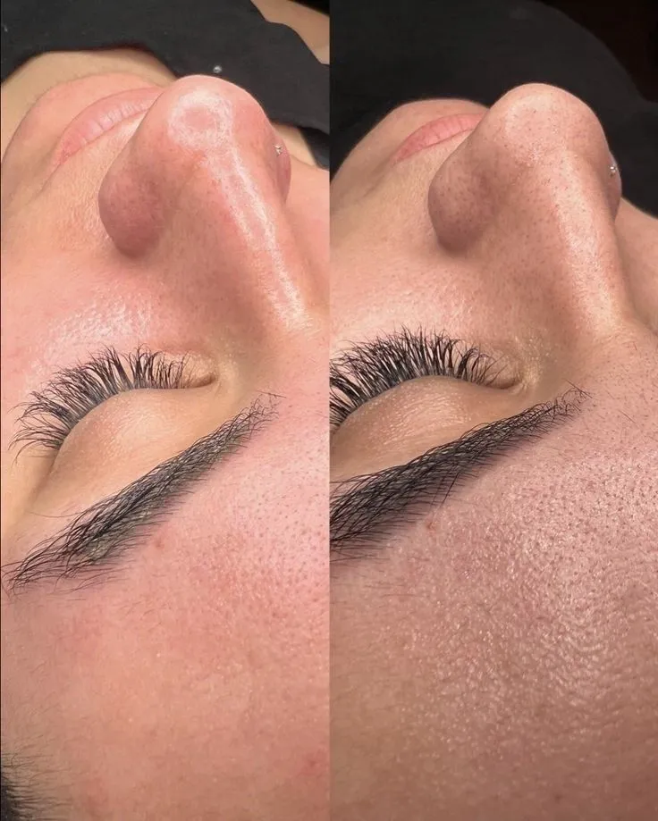 Machine hydraface hydrodermabrasion avant apres visage, résultat peau lumineuse et lisse, soin professionnel de rajeunissement cutané en institut
