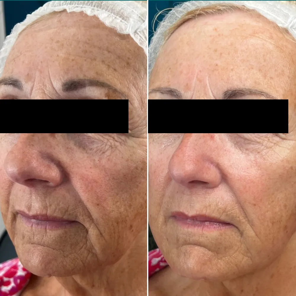 25D-360Max HIFU RF EMS anti-aging machine before and after anti-aging-result