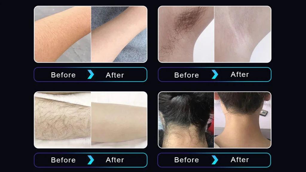 808nm diode laser hair removal before and after results