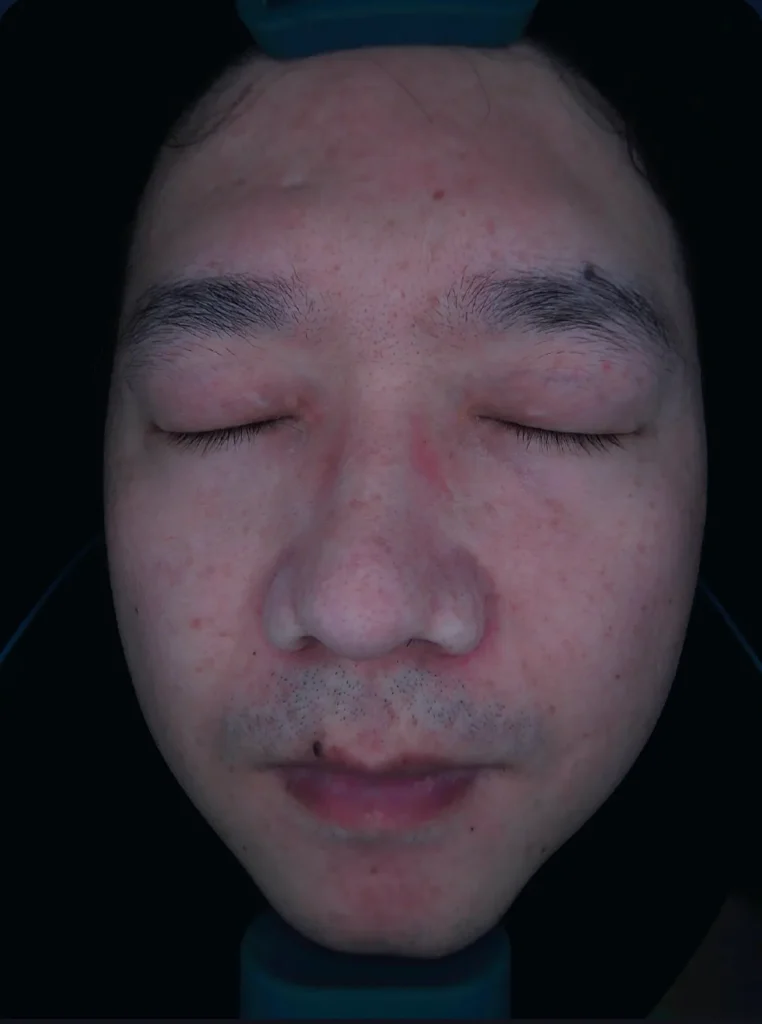 Intelligent skin analyzer 8-spectrum negative polarized light skin analysis result