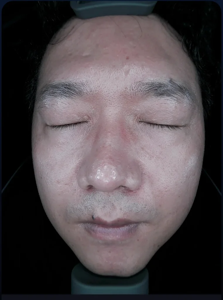 Intelligent skin analyzer 8-spectrum positive polarized light skin analysis result