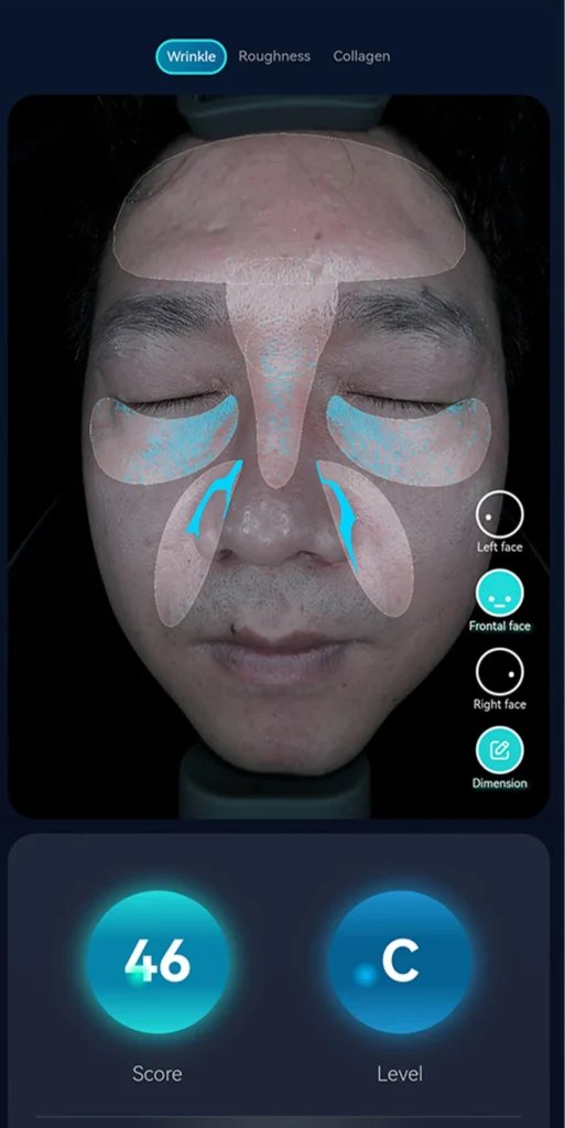 AI intelligent skin analyzer showing aging and fine line analysis on facial skin