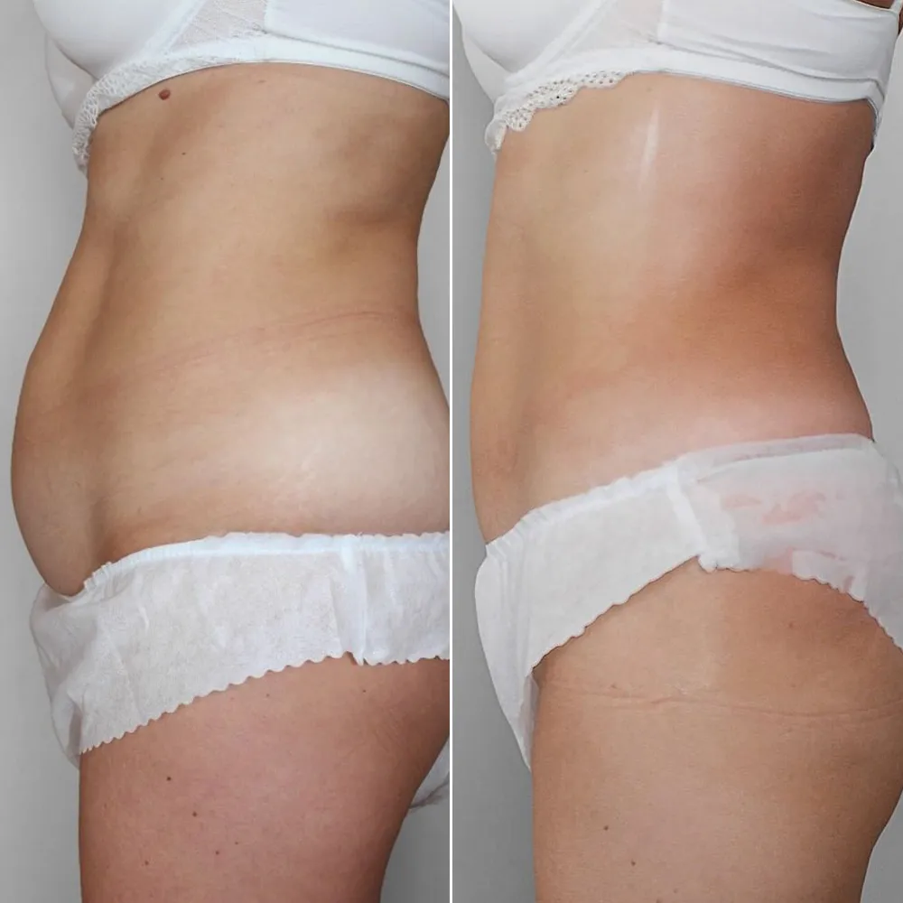 MagSculpt Neo before and after results for body sculpting