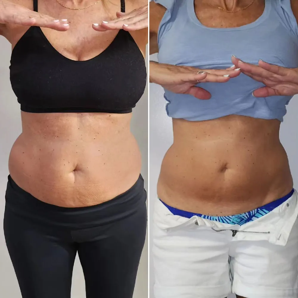 Cryolipolysis before and after results for belly fat reduction