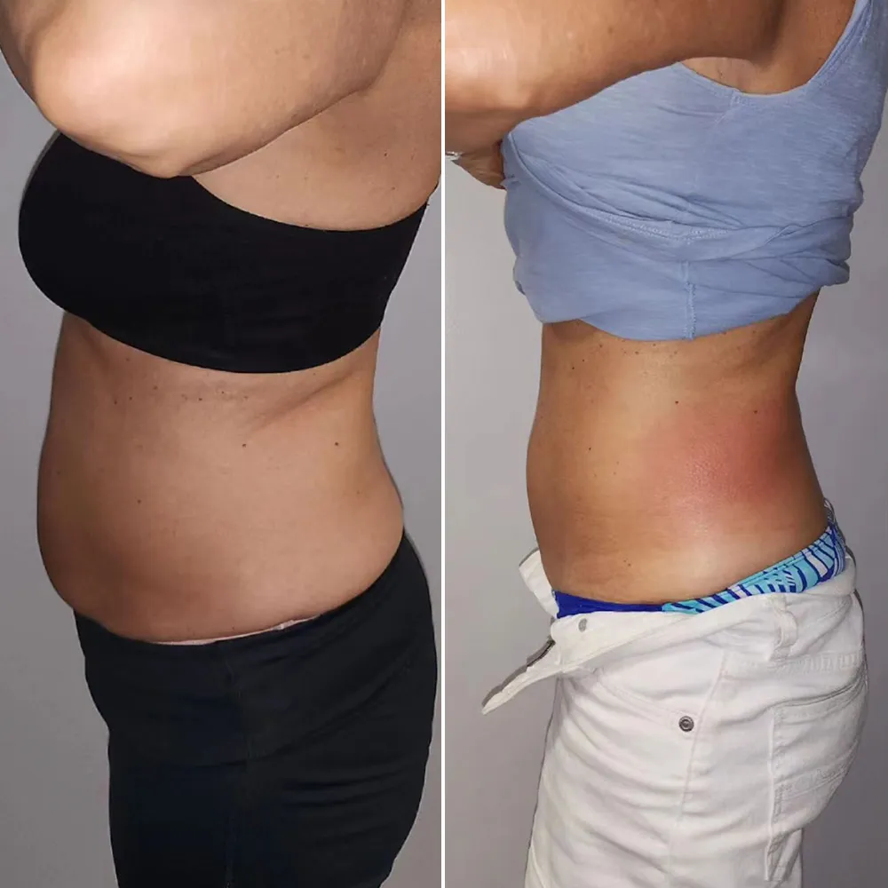 Cryolipolysis side view before and after for waist fat reduction