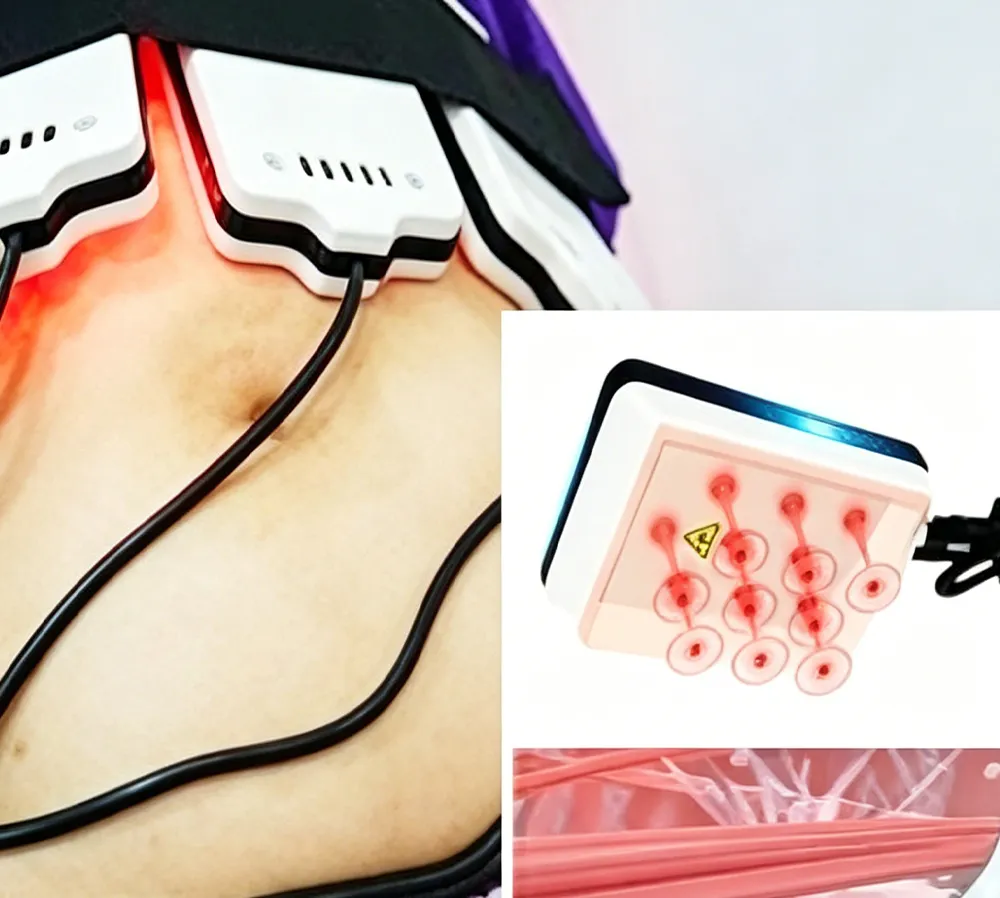 Multifunctional cryolipolysis machine with lipolaser pads for fat reduction and body contouring