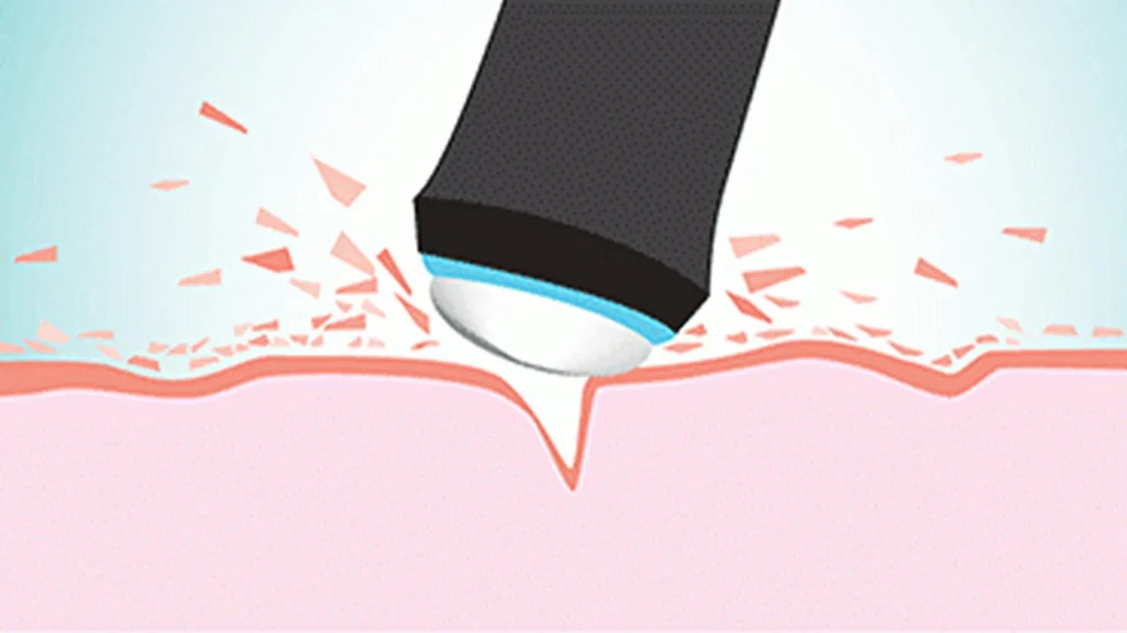 Oxygen Bubble Facial Machine Skin Exfoliation Principle Diagram