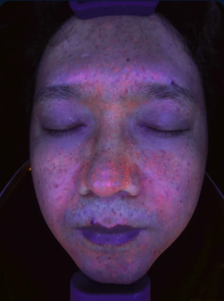 Résultat lumière UV 8 spectres Analyseur de peau intelligent par IA détection UV et pigmentations cachées