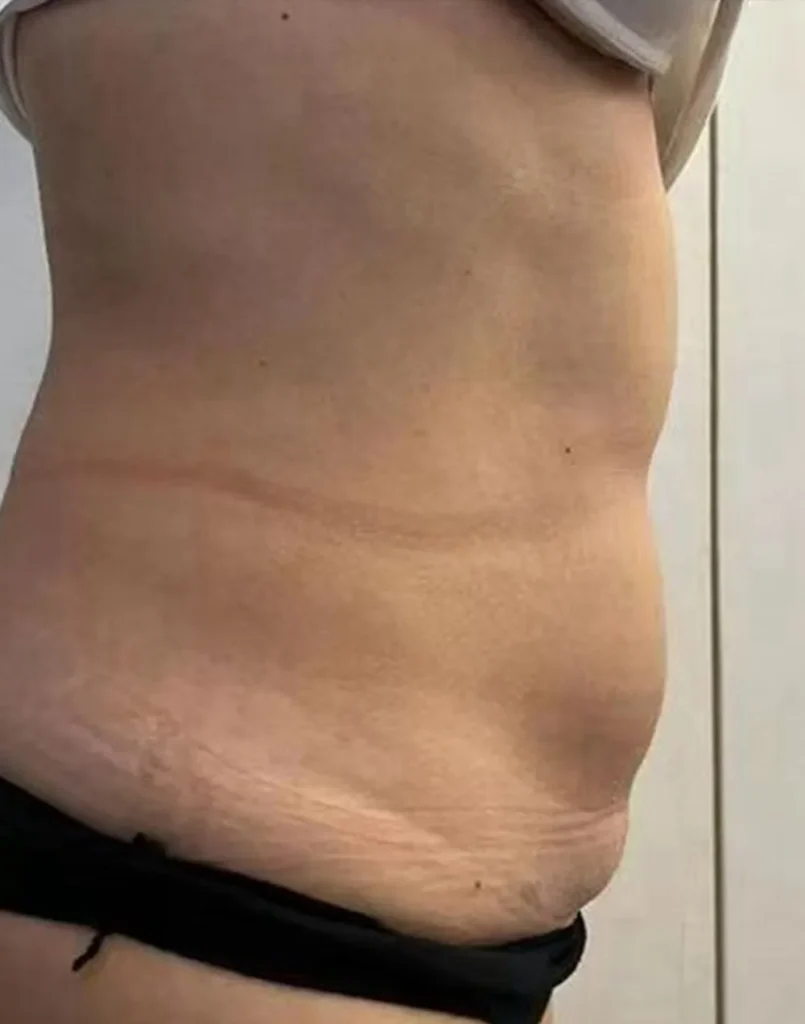 after belly treatment of 360 surrounded cryo slim machine with 2 handles for cryolipolysis fat freezing