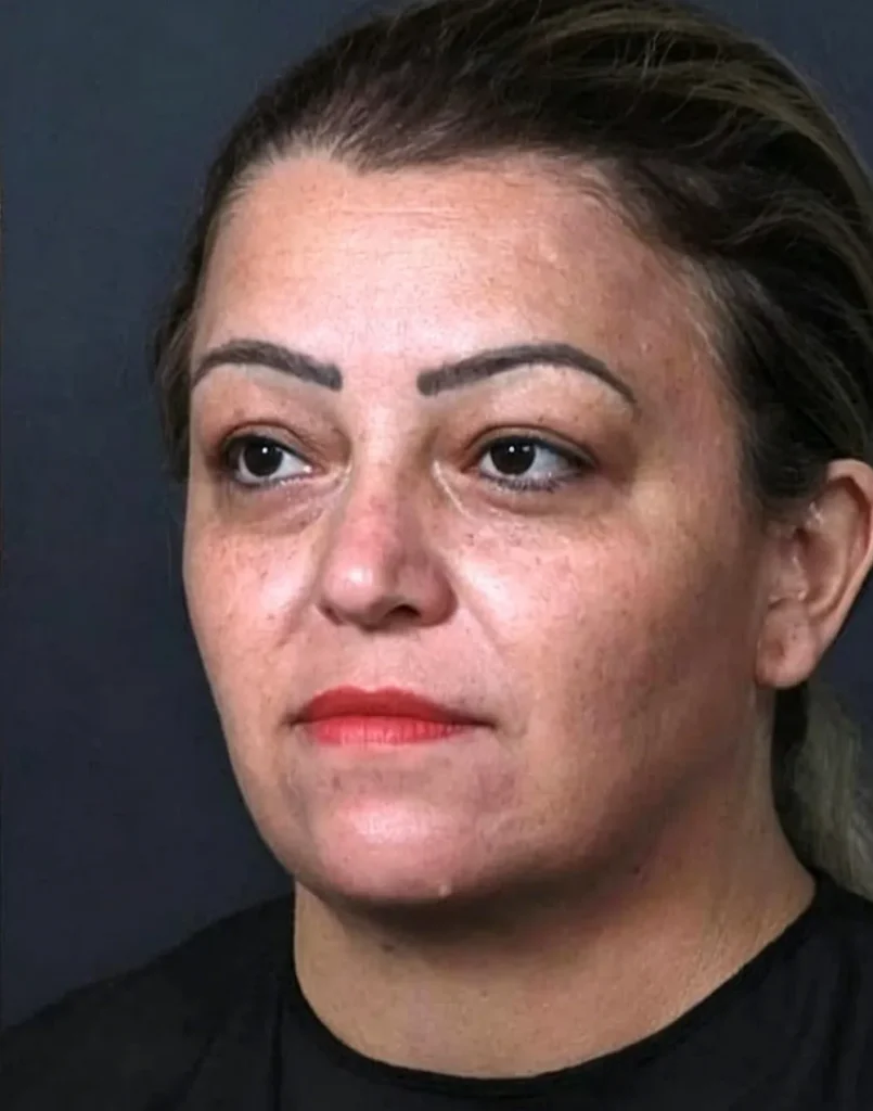 after double chin treatment of 360 surrounded cryo slim machine with 2 handles for fat loss