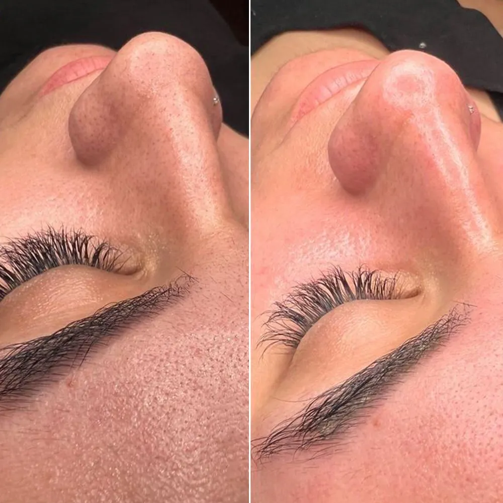 machine hydradermabrasion résultat avant après peau éclatante nettoyage visage institut beauté