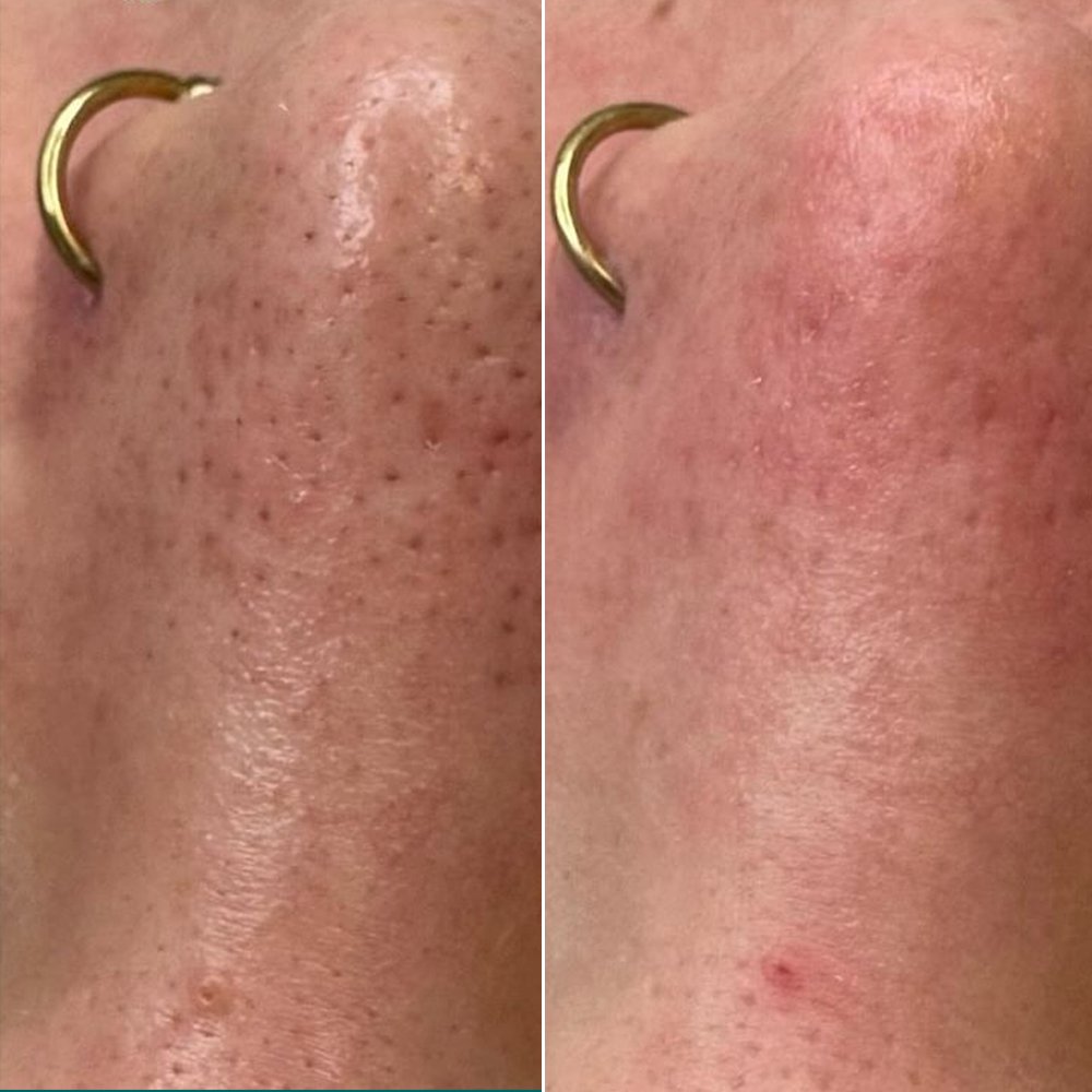 machine hydradermabrasion avant après nettoyage profond peau points noirs pores serrés