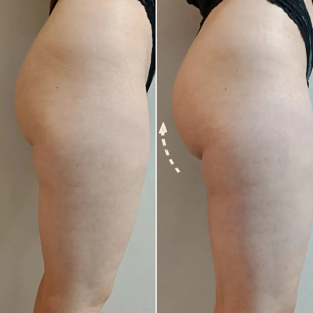 Machine Amincissante lifting fesses avant après remodelage fessier magnétique RF