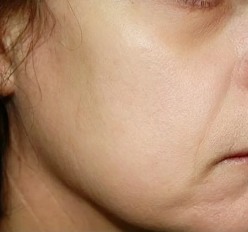 Oxygen facial machine after treatment close-up of glowing smooth facial skin with refined pores and even tone