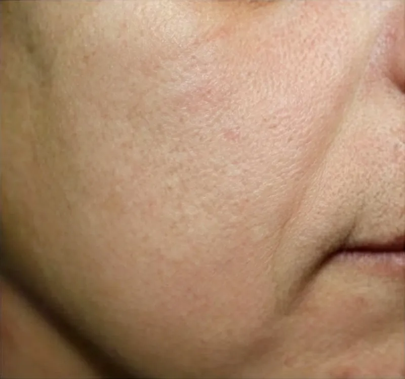 Before treatment facial photo for oxygenating facial machine, showing dull uneven skin, fine lines and pigmentation before oxygen infusion skincare therapy