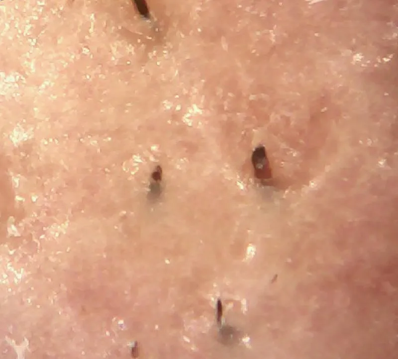 Microscope after-treatment skin photo for oxygenating facial machine, clean unclogged pores with reduced blackheads and smooth skin after oxygen deep exfoliation therapy