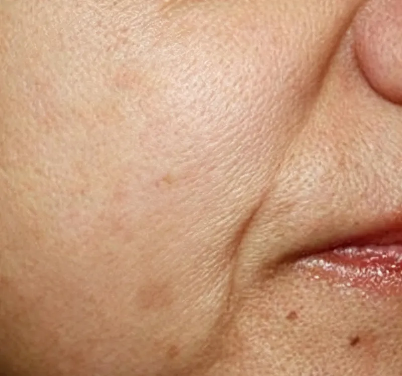 After oxygen facial machine treatment close-up photo showing brightened, smoother skin with faded pigment spots and even skin tone