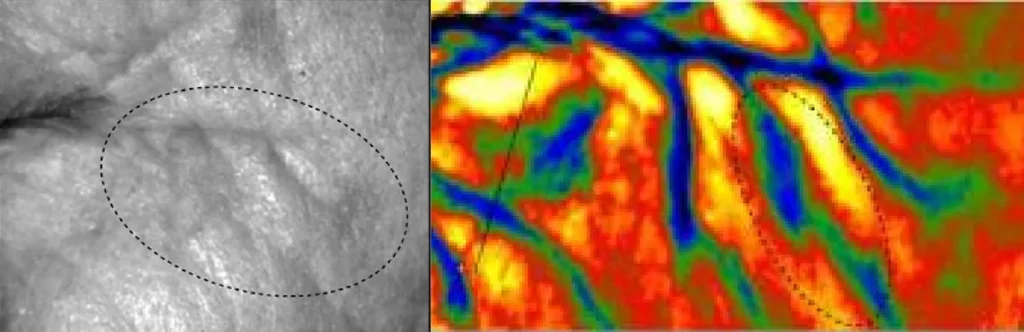 After tripolar radio frequency thermal scan image for oxygenating facial machine, thermal mapping showing improved collagen density, tightened skin and reduced wrinkles post RF anti-aging treatment