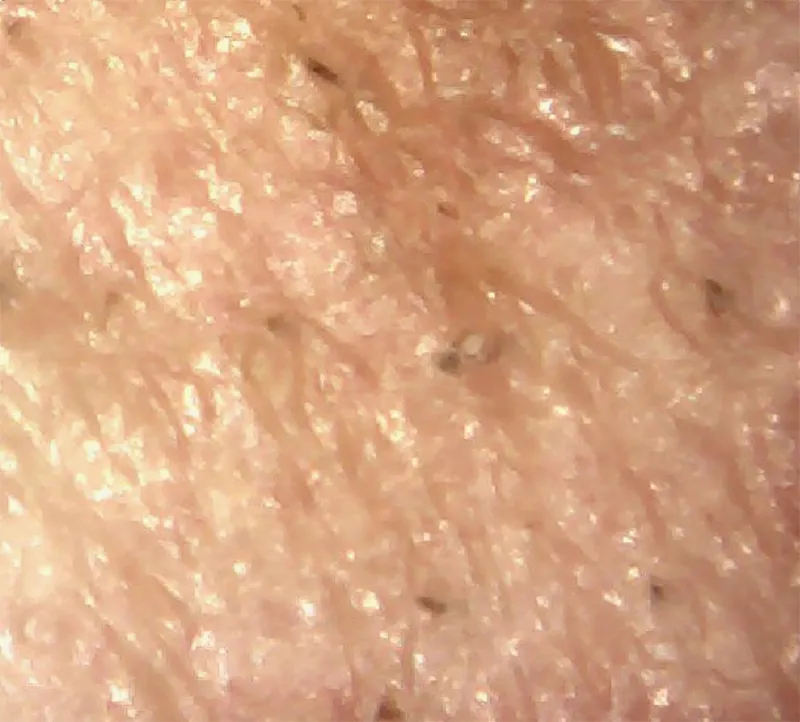 Microscopic magnified pre-treatment skin image for oxygenating facial machine, showing clogged pores, excess sebum and blackheads before deep oxygen facial exfoliation