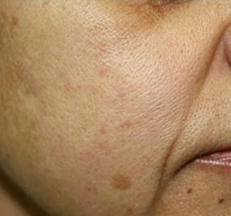 Before treatment facial photo for oxygenating facial machine, facial skin with obvious pigment spots, dull tone and rough texture before oxygen infusion facial care