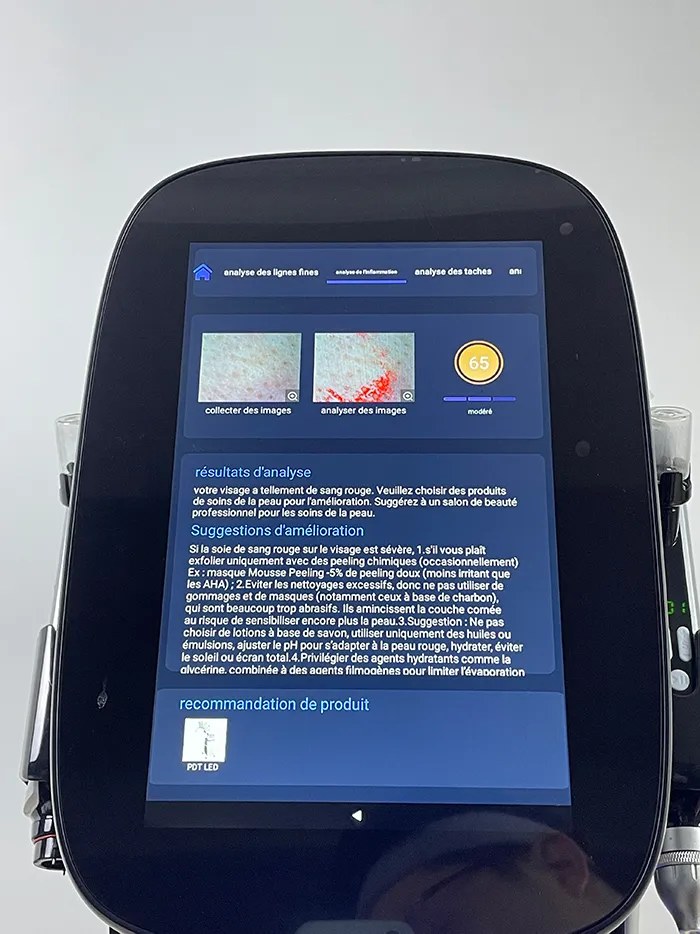 Step 13 for Skin Analysis System operation on Hydro Dermabrasion Facial Machine, display the skin inflammation analysis report