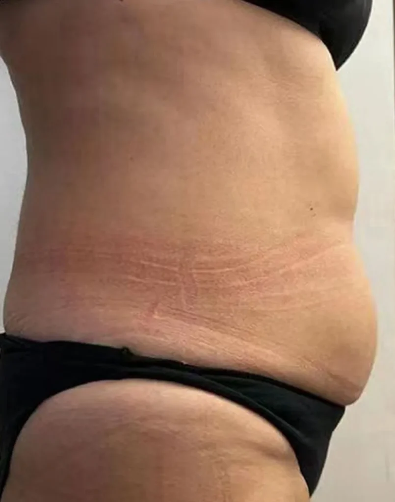 before belly treatment of 360 surrounded cryo slim machine with 2 handles for cryolipolysis fat freezing