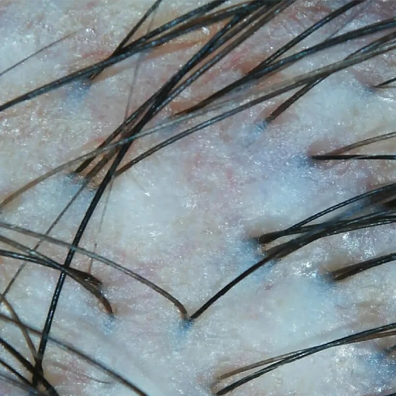 Hair and scalp analysis machine white‑light magnified scalp hair follicle inspection image