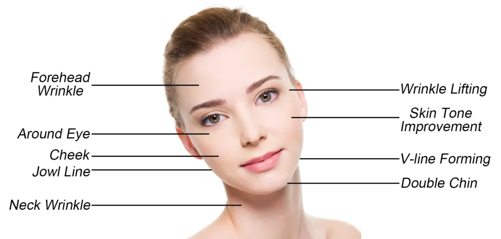 7D Portable HIFU machine face treatment areas diagram, facial lifting and anti-aging treatment zones for HIFU skin tightening