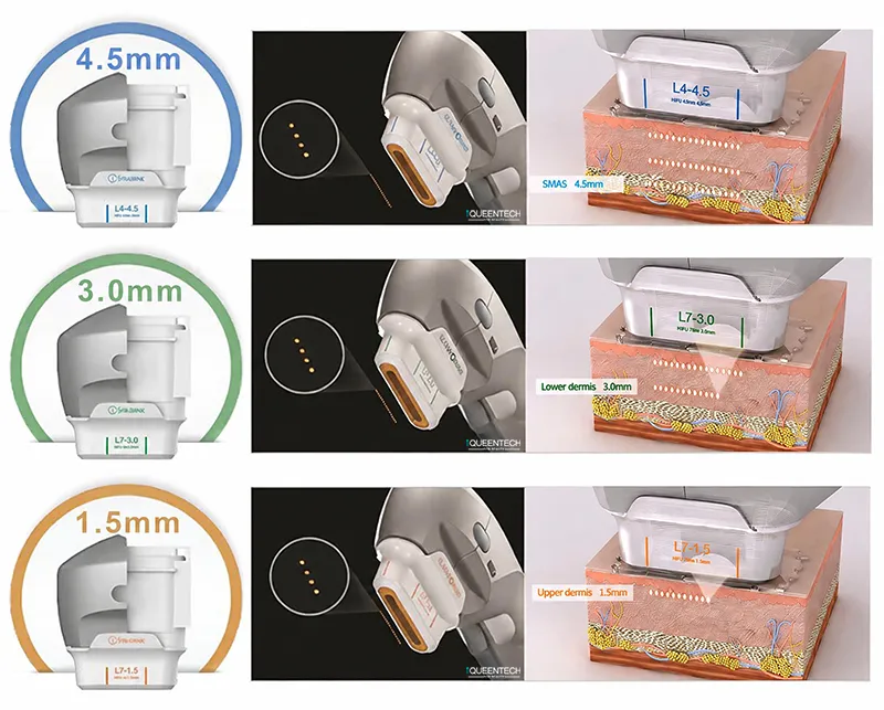 Machine HIFU 7D Visage Portable cartouches de traitement pour visage, différentes profondeurs de pénétration cutanée