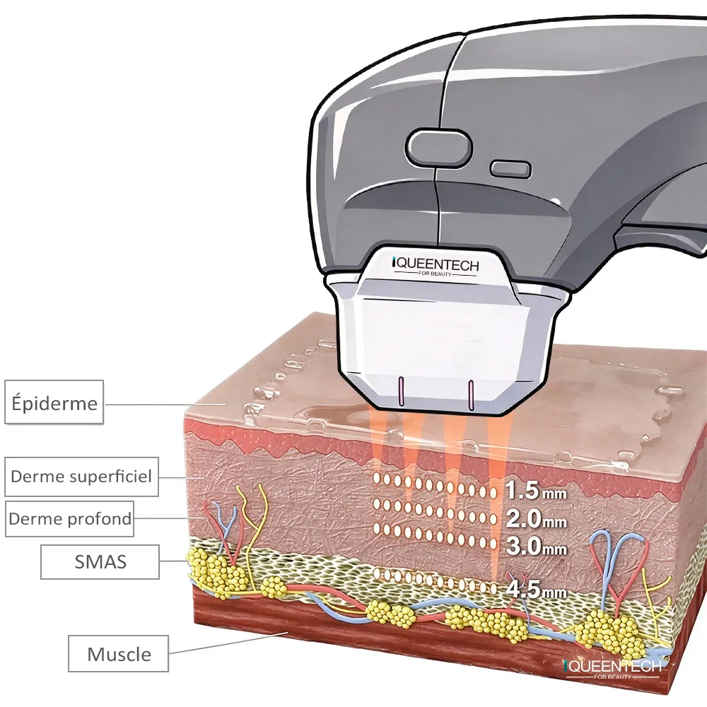 Machine HIFU 7D Visage Portable schéma principe de fonctionnement, ultrasons focalisés sur différentes couches de la peau