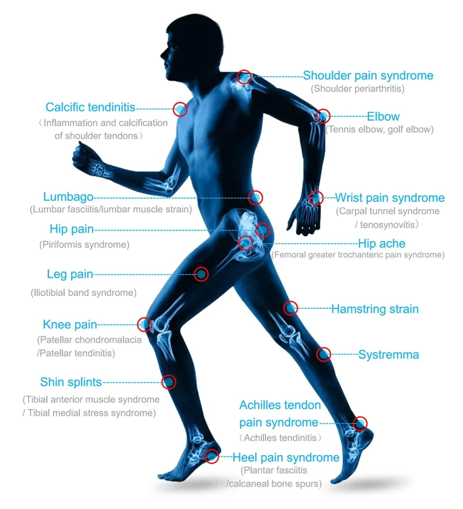Treatment indications diagram for Piezoelectric Focused Shockwave Therapy Machine, human body pain points chart for shockwave physiotherapy