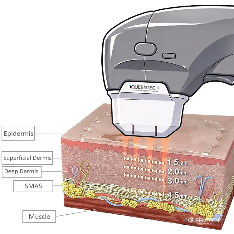 7D Portable HIFU machine working principle diagram, HIFU handpiece delivering focused ultrasound energy into different skin layers for facial lifting and anti-aging treatment